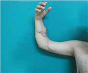 TRAKYA ÜNİVERSİTESİ’NDE KOPAN KOL BAŞARILI BİR ŞEKİLDE REPLANTE EDİLDİ