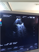 ENDOBRONŞİAL ULTRASONOGRAFİ SİSTEMİ HİZMETE GİRDİ